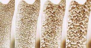 Apa itu Osteoporosis,  Mencegahnya Caranya Bagaimana?